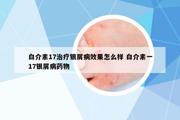 白介素17治療銀屑病效果怎么樣 白介素一17銀屑病藥物