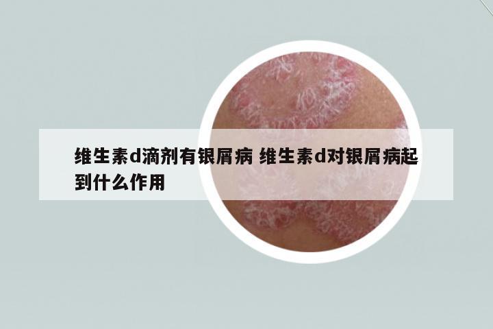 維生素d滴劑有銀屑病 維生素d對(duì)銀屑病起到什么作用