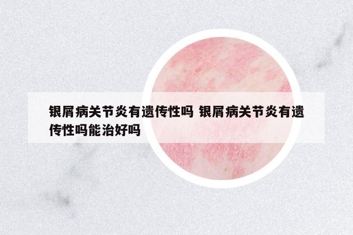 銀屑病關節(jié)炎有遺傳性嗎 銀屑病關節(jié)炎有遺傳性嗎能治好嗎
