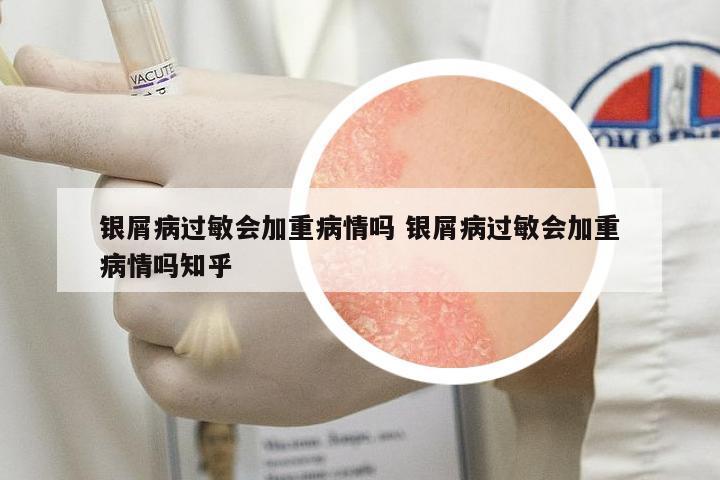銀屑病過敏會加重病情嗎 銀屑病過敏會加重病情嗎知乎