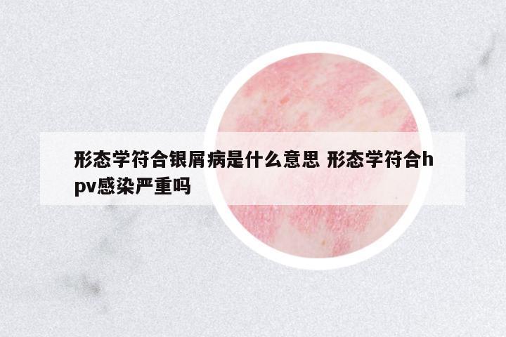 形態(tài)學(xué)符合銀屑病是什么意思 形態(tài)學(xué)符合hpv感染嚴(yán)重嗎