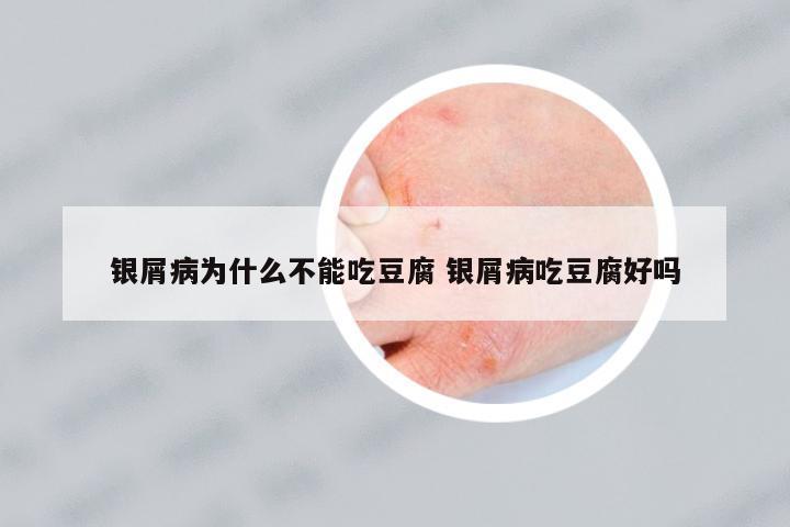 銀屑病為什么不能吃豆腐 銀屑病吃豆腐好嗎