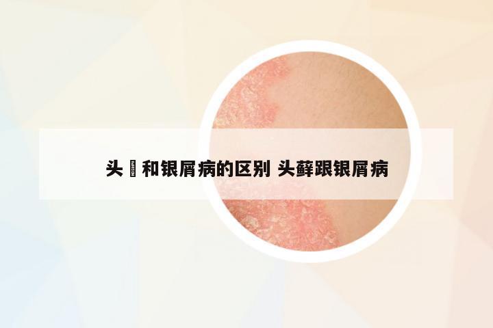 頭廯和銀屑病的區(qū)別 頭蘚跟銀屑病