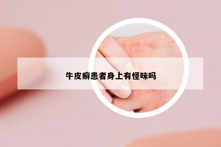 牛皮癬患者身上有怪味嗎
