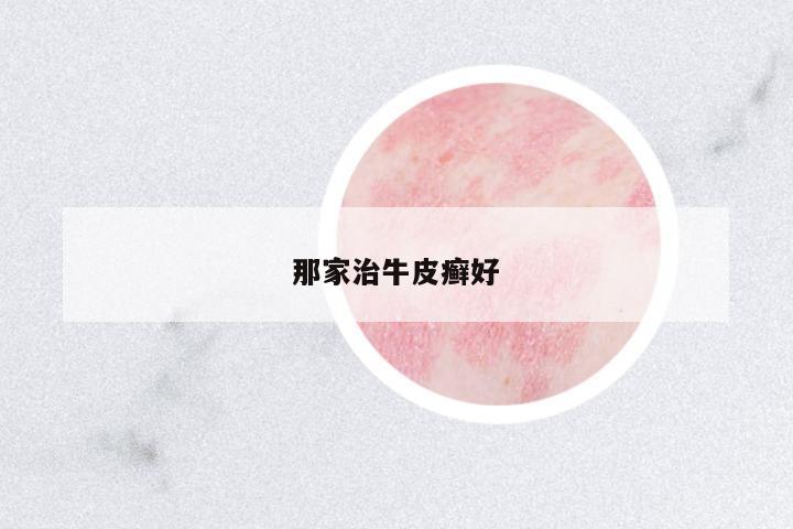 那家治牛皮癬好