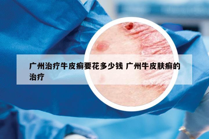 廣州治療牛皮癬要花多少錢 廣州牛皮膚癬的治療