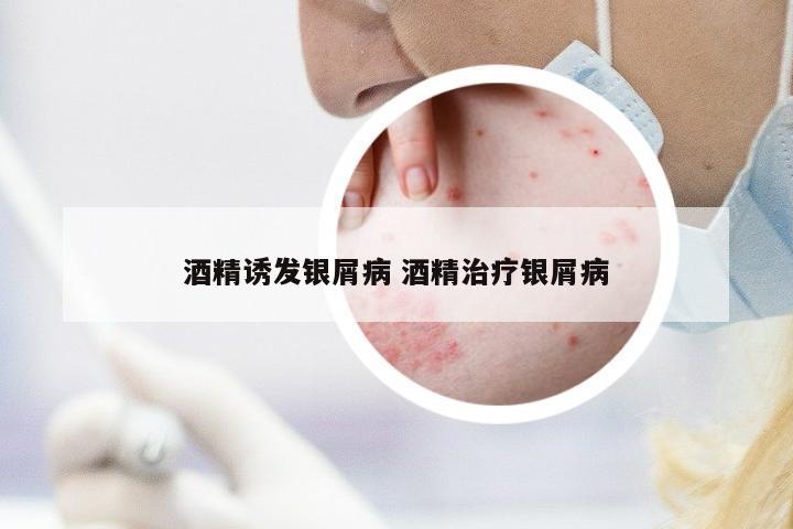 酒精誘發(fā)銀屑病 酒精治療銀屑病