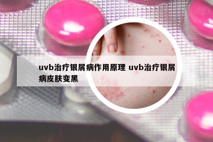 uvb治療銀屑病作用原理 uvb治療銀屑病皮膚變黑