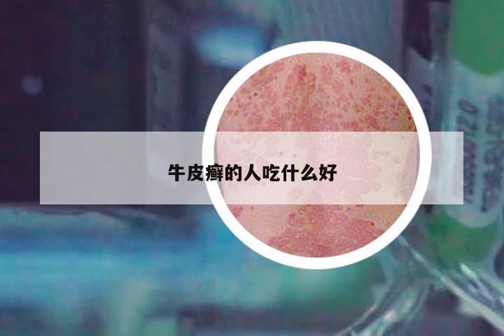 牛皮癬的人吃什么好