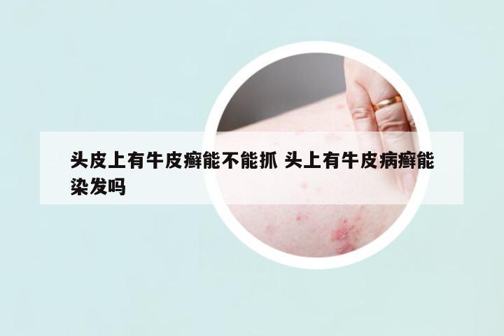 頭皮上有牛皮癬能不能抓 頭上有牛皮病癬能染發(fā)嗎