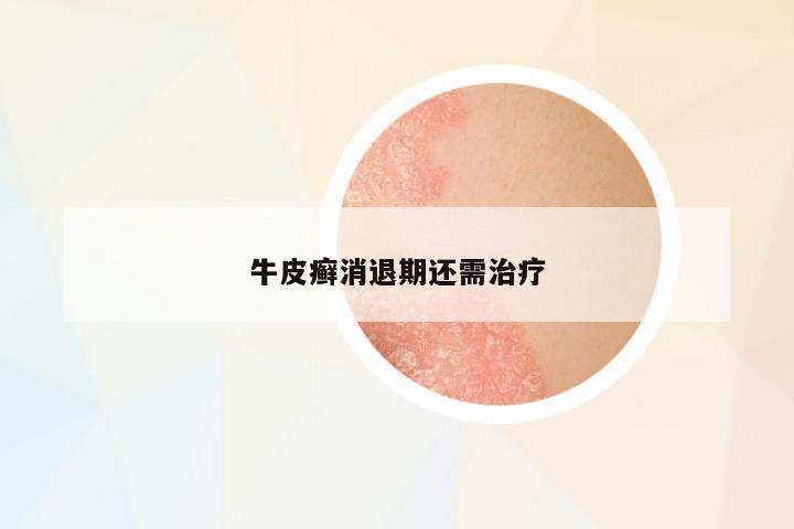 牛皮癬消退期還需治療
