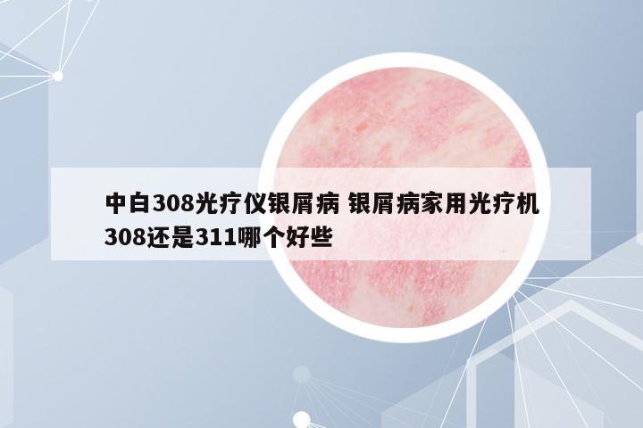 中白308光療儀銀屑病 銀屑病家用光療機308還是311哪個好些