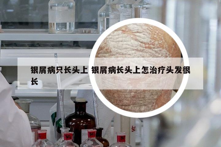 銀屑病只長頭上 銀屑病長頭上怎治療頭發(fā)很長