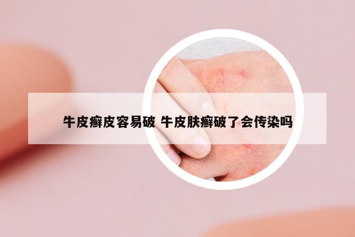 牛皮癬皮容易破 牛皮膚癬破了會(huì)傳染嗎
