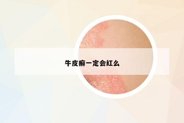 牛皮癬一定會(huì)紅么
