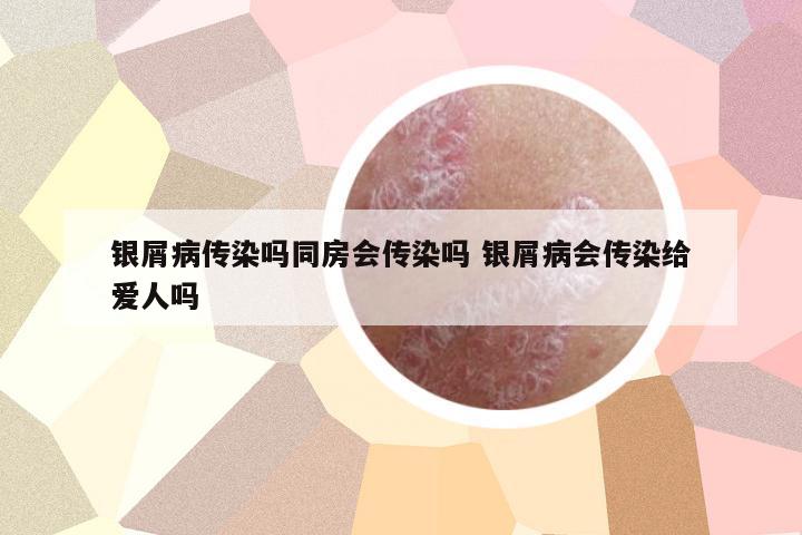 銀屑病傳染嗎同房會(huì)傳染嗎 銀屑病會(huì)傳染給愛人嗎