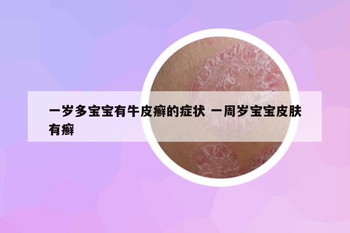 一歲多寶寶有牛皮癬的癥狀 一周歲寶寶皮膚有癬