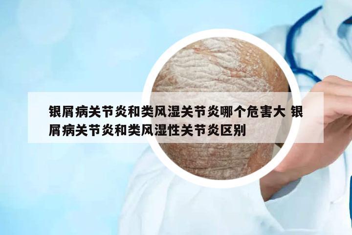 銀屑病關(guān)節(jié)炎和類風(fēng)濕關(guān)節(jié)炎哪個危害大 銀屑病關(guān)節(jié)炎和類風(fēng)濕性關(guān)節(jié)炎區(qū)別