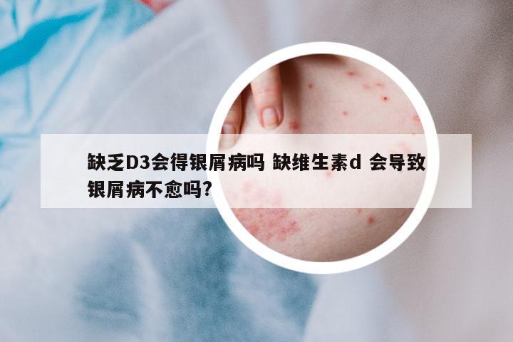 缺乏D3會得銀屑病嗎 缺維生素d 會導致銀屑病不愈嗎?