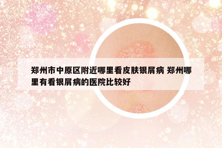 鄭州市中原區(qū)附近哪里看皮膚銀屑病 鄭州哪里有看銀屑病的醫(yī)院比較好