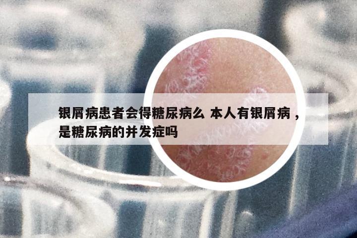銀屑病患者會(huì)得糖尿病么 本人有銀屑病 ,是糖尿病的并發(fā)癥嗎