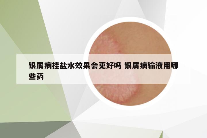 銀屑病掛鹽水效果會更好嗎 銀屑病輸液用哪些藥