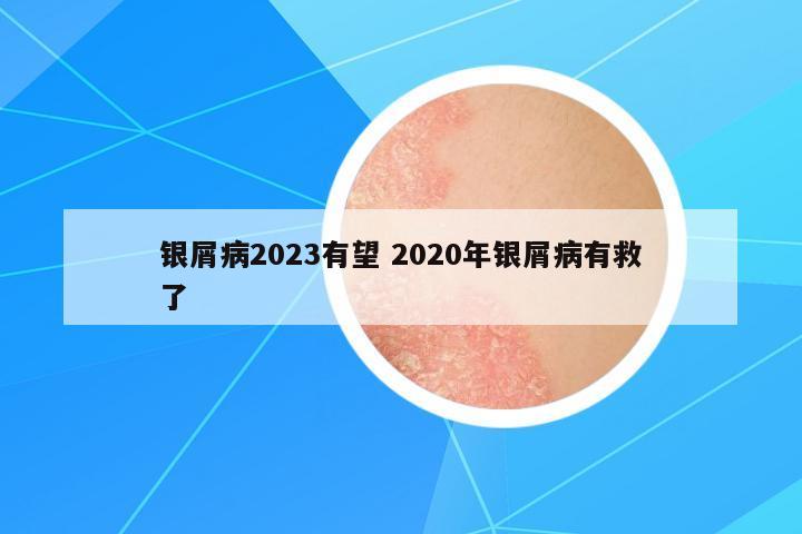 銀屑病2023有望 2020年銀屑病有救了