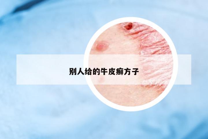 別人給的牛皮癬方子