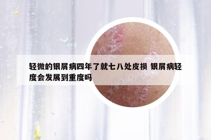 輕微的銀屑病四年了就七八處皮損 銀屑病輕度會發(fā)展到重度嗎