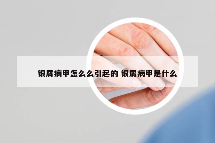 銀屑病甲怎么么引起的 銀屑病甲是什么