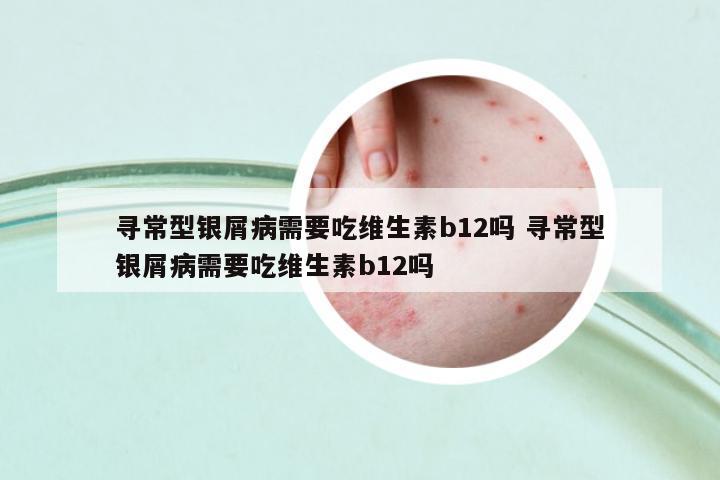 尋常型銀屑病需要吃維生素b12嗎 尋常型銀屑病需要吃維生素b12嗎