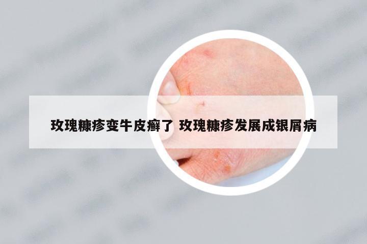 玫瑰糠疹變牛皮癬了 玫瑰糠疹發(fā)展成銀屑病