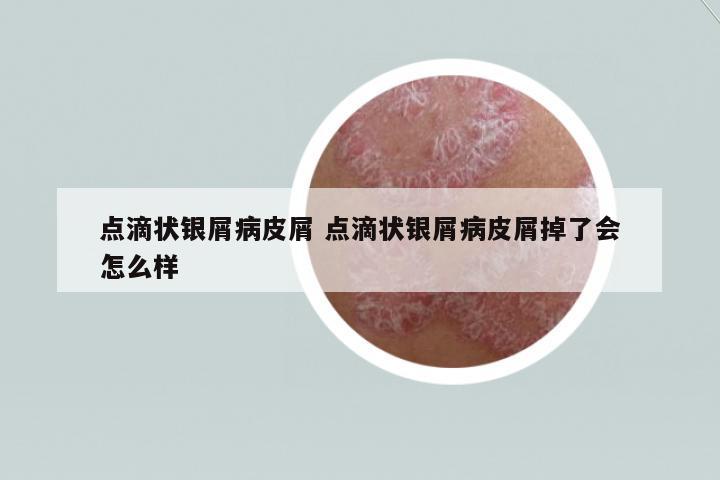 點滴狀銀屑病皮屑 點滴狀銀屑病皮屑掉了會怎么樣
