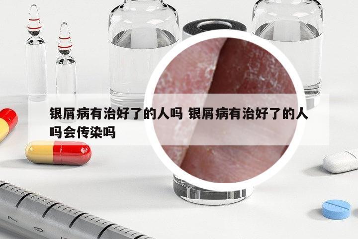 銀屑病有治好了的人嗎 銀屑病有治好了的人嗎會(huì)傳染嗎
