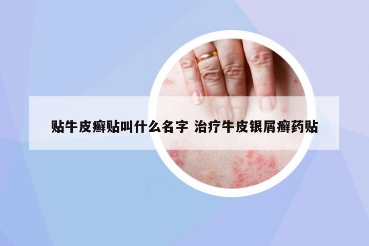 貼牛皮癬貼叫什么名字 治療牛皮銀屑癬藥貼