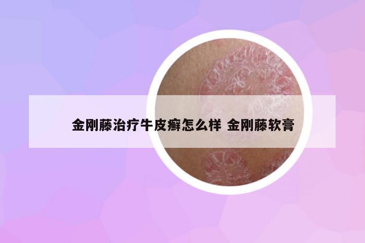 金剛藤治療牛皮癬怎么樣 金剛藤軟膏