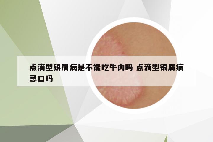 點(diǎn)滴型銀屑病是不能吃牛肉嗎 點(diǎn)滴型銀屑病忌口嗎