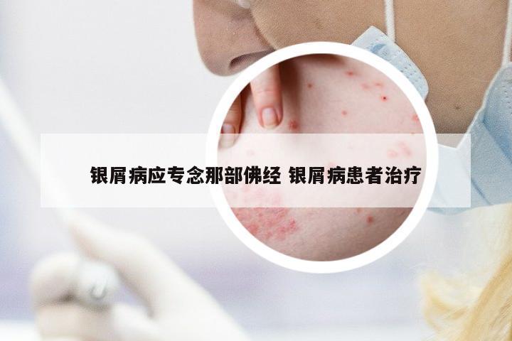 銀屑病應(yīng)專念那部佛經(jīng) 銀屑病患者治療