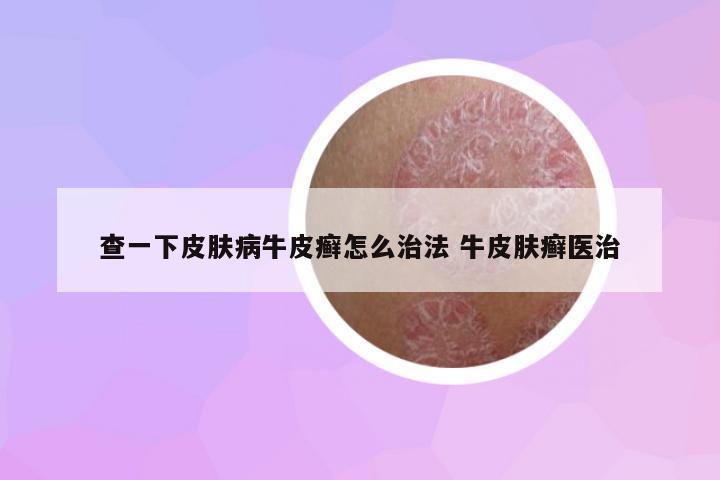 查一下皮膚病牛皮癬怎么治法 牛皮膚癬醫(yī)治
