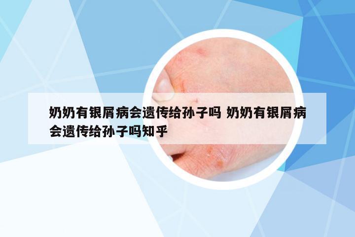 奶奶有銀屑病會遺傳給孫子嗎 奶奶有銀屑病會遺傳給孫子嗎知乎