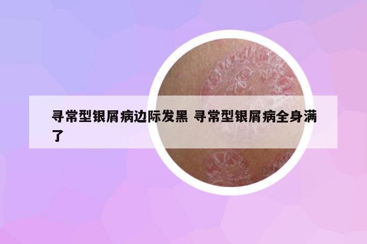 尋常型銀屑病邊際發(fā)黑 尋常型銀屑病全身滿了