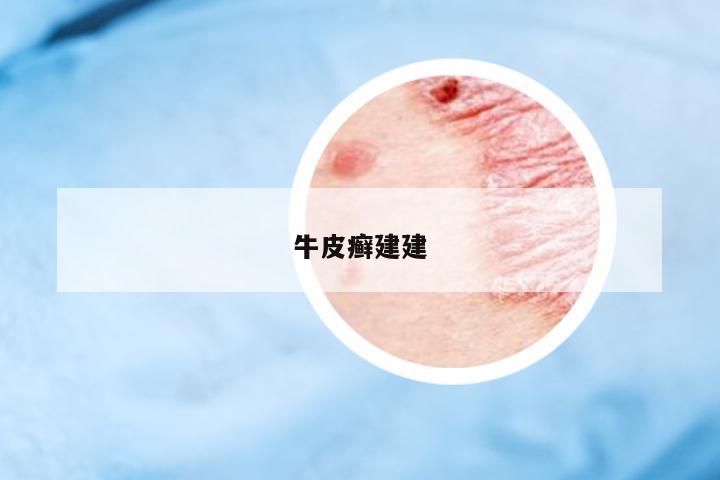 牛皮癬建建