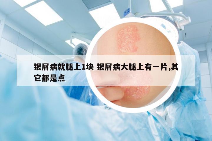 銀屑病就腿上1塊 銀屑病大腿上有一片,其它都是點(diǎn)