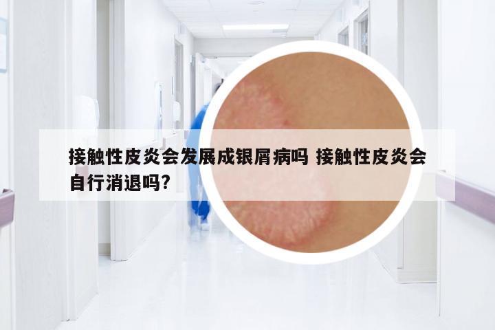 接觸性皮炎會發(fā)展成銀屑病嗎 接觸性皮炎會自行消退嗎?