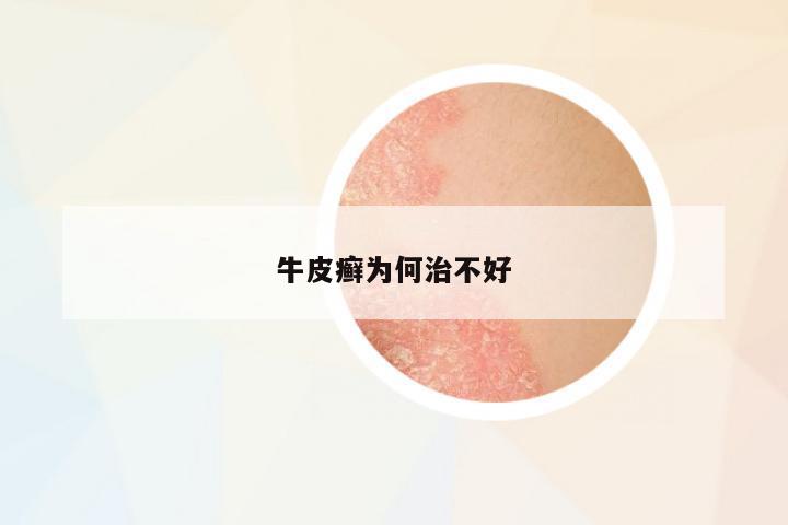 牛皮癬為何治不好
