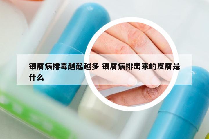 銀屑病排毒越起越多 銀屑病排出來的皮屑是什么