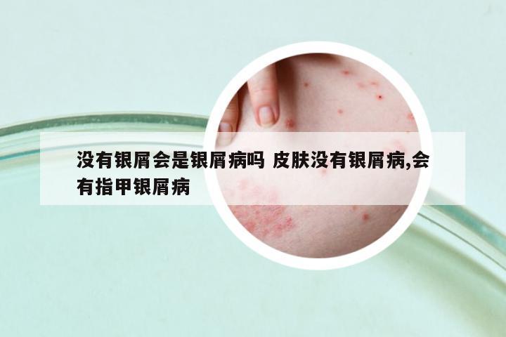 沒(méi)有銀屑會(huì)是銀屑病嗎 皮膚沒(méi)有銀屑病,會(huì)有指甲銀屑病