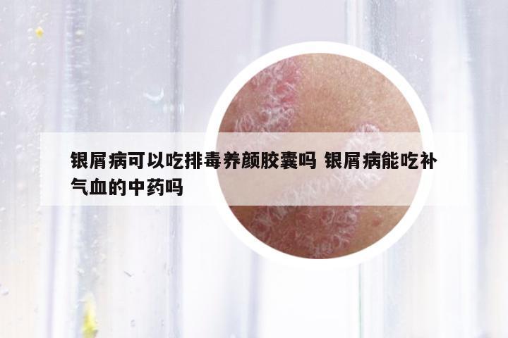 銀屑病可以吃排毒養(yǎng)顏膠囊嗎 銀屑病能吃補(bǔ)氣血的中藥嗎