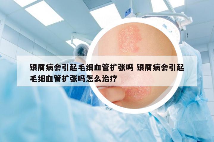銀屑病會引起毛細血管擴張嗎 銀屑病會引起毛細血管擴張嗎怎么治療