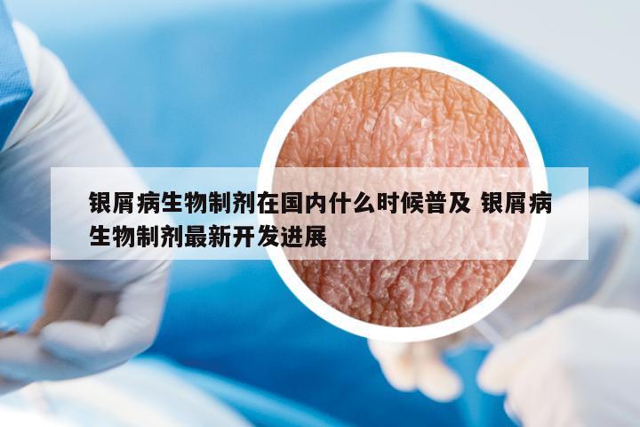 銀屑病生物制劑在國內(nèi)什么時候普及 銀屑病生物制劑最新開發(fā)進(jìn)展